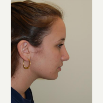 18-24 year old woman treated with Rhinoplasty after 3143511