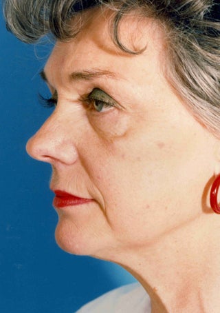 Facelift 1047987