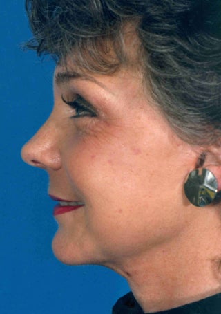 Facelift 1047987