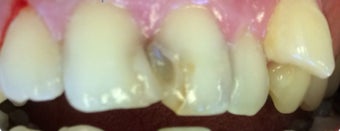 45-54 year old woman treated with Dental Crown before 3379423