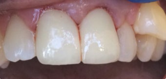 45-54 year old woman treated with Dental Crown after 3379423