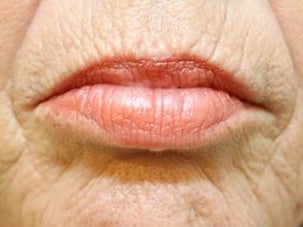 Injectable Fillers before 1076885