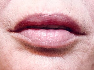 Injectable Fillers after 1076885