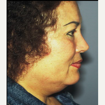 45-54 year old woman treated with Facelift before 3710276