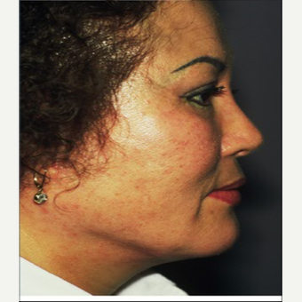 45-54 year old woman treated with Facelift after 3710276