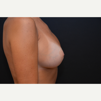 25-34 year old woman treated with Breast Augmentation after 3265257