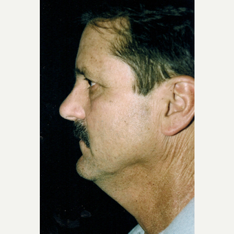 55-64 year old man treated with Neck Lift before 3271794