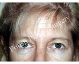 Forehead Lift before 921876