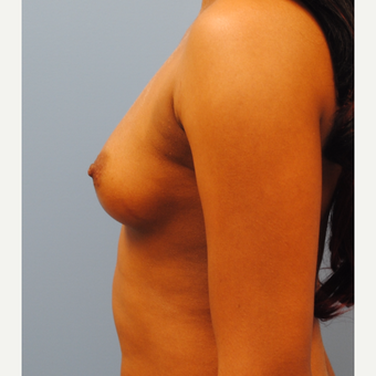 25-34 year old woman treated with Breast Augmentation before 3061445