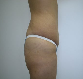 Abdominoplasty after 531866