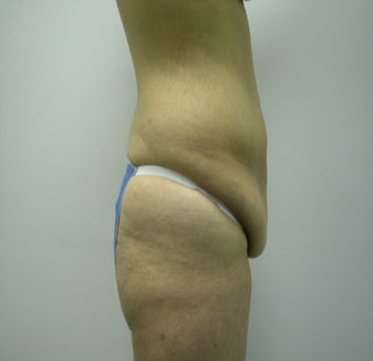 Abdominoplasty before 531866
