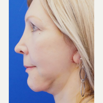 55-64 year old woman treated with Chin Implant after 3719127