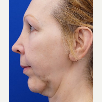 55-64 year old woman treated with Chin Implant before 3719127