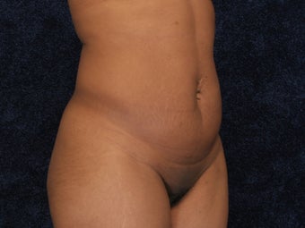 Abdominoplasty and Liposuction to Hips 322001