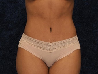 Abdominoplasty and Liposuction to Hips after 322001