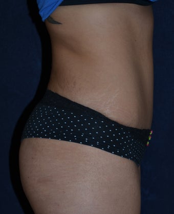 Tummy Tuck with Liposuction to Flanks 1321331