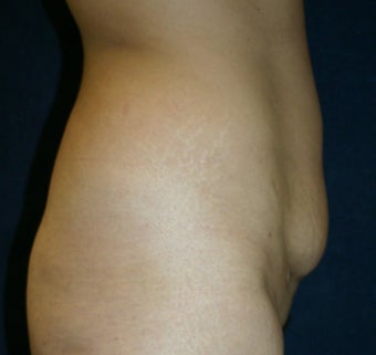 Tummy Tuck with Liposuction to Flanks 1321331