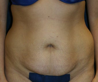 Tummy Tuck with Liposuction to Flanks before 1321331