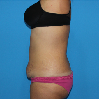 35-44 year old woman treated with Tummy Tuck before 3332925