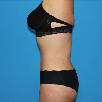 35-44 year old woman treated with Tummy Tuck after 3332925