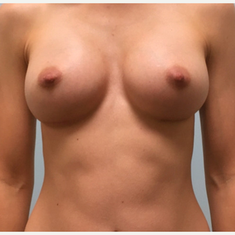 Breast augmentation with Natrelle Gel 410 Anatomically Shaped Implants on 5'2, 103lb patient after 3076206