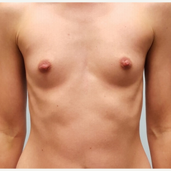 Breast augmentation with Natrelle Gel 410 Anatomically Shaped Implants on 5'2, 103lb patient before 3076206