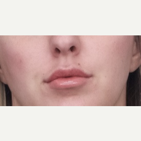 25-34 year old woman treated with Restylane Silk after 3764110