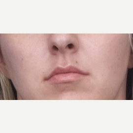 25-34 year old woman treated with Restylane Silk before 3764110