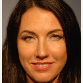 35-44 year old woman treated with Restylane for Rejuvenation of the Lower Eyelids before 2772117