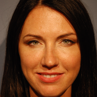 35-44 year old woman treated with Restylane for Rejuvenation of the Lower Eyelids after 2772117