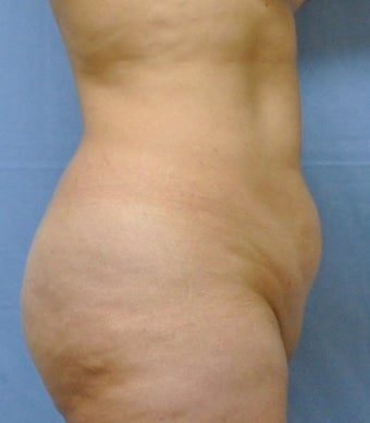 35-44 year old woman treated with Tummy Tuck before 2553447