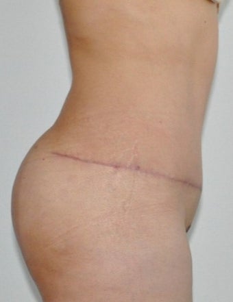 35-44 year old woman treated with Tummy Tuck after 2553447