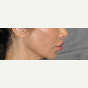 35-44 year old woman treated with Lip Lift after 3175738