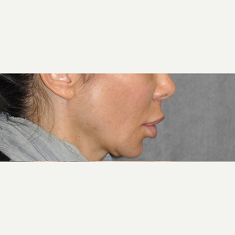 35-44 year old woman treated with Lip Lift before 3175738
