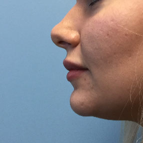 25-34 year old woman treated with Lip Augmentation after 3679415