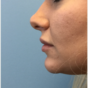 25-34 year old woman treated with Lip Augmentation before 3679415