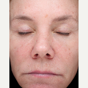 54 year old woman treated with Halo Laser and BBL before 3656518