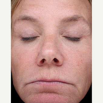 54 year old woman treated with Halo Laser and BBL after 3656518