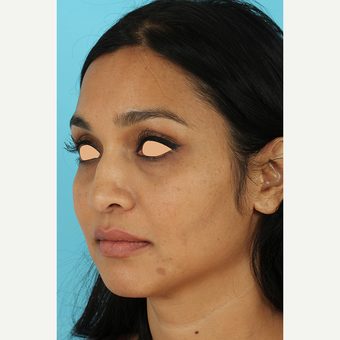 25-34 year old woman treated with Revision Rhinoplasty before 3691216