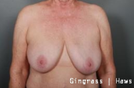Breast Implant Removal after 1383963
