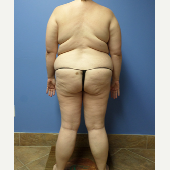 35-44 year old woman treated with Weight Loss after 3370123