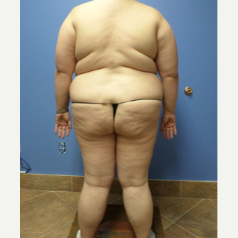 35-44 year old woman treated with Weight Loss before 3370123