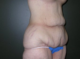 Tummy Tuck after Massive Weight Loss 1205262