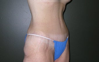Tummy Tuck after Massive Weight Loss 1205262