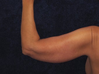 54 Year Old Female Brachioplasty (Armlift) 1419671