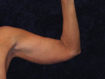 54 Year Old Female Brachioplasty (Armlift) after 1419671