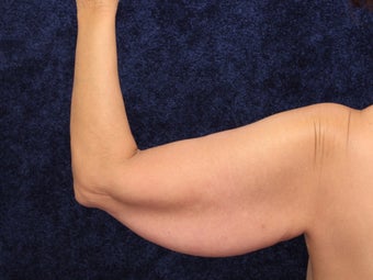 54 Year Old Female Brachioplasty (Armlift) 1419671