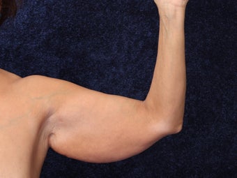 54 Year Old Female Brachioplasty (Armlift) before 1419671