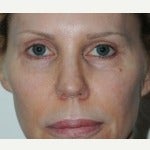 35-44 year old woman treated with Fat Transfer before 2546449