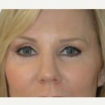 35-44 year old woman treated with Fat Transfer after 2546449